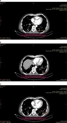 Case Report: Combination of Olaparib With Chemotherapy in a Patient With ATM-Deficient Colorectal Cancer